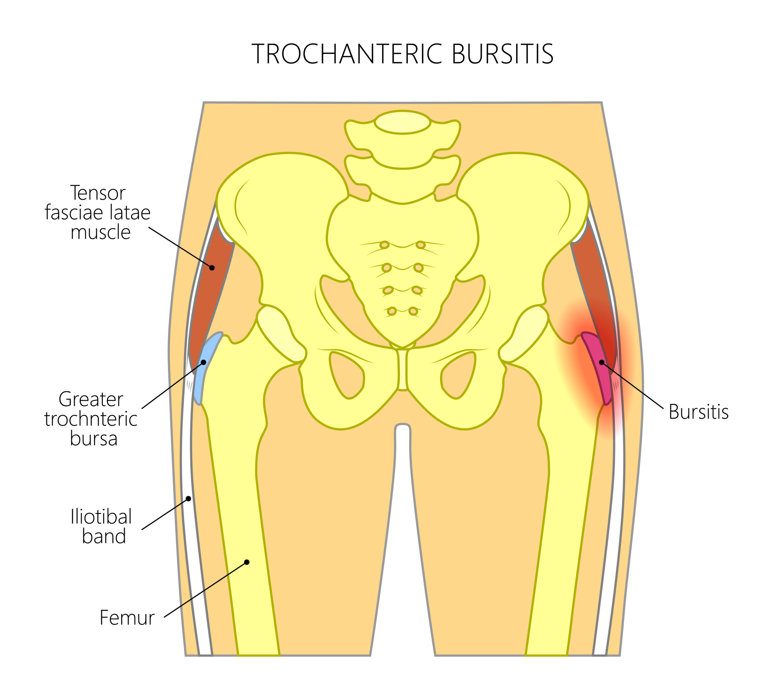 csípőízületek bursitis kezelése a vállízület sokáig fáj